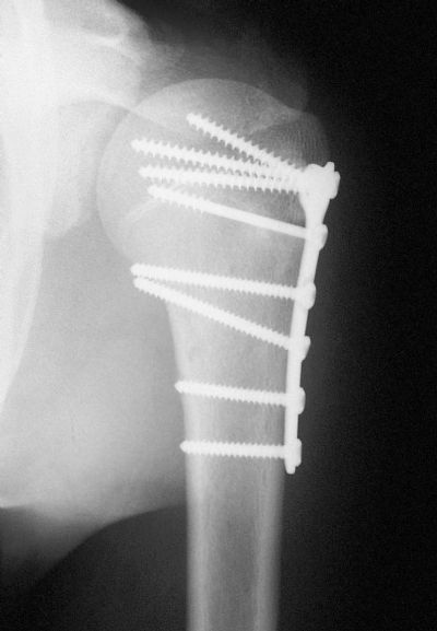 Synthes Ti T-Plate (Implant 254)